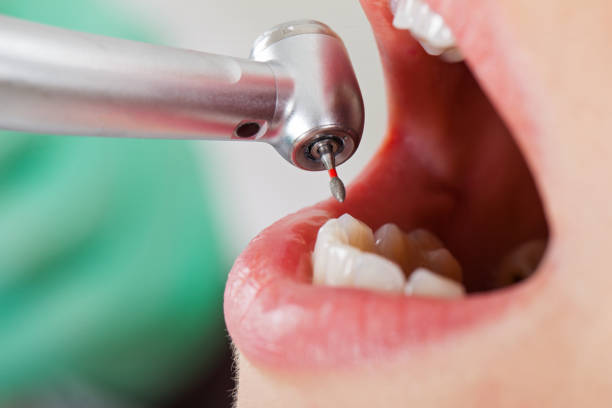 Best Emergency Treatment for Dental Infections or Abscesses in Anderson, IN